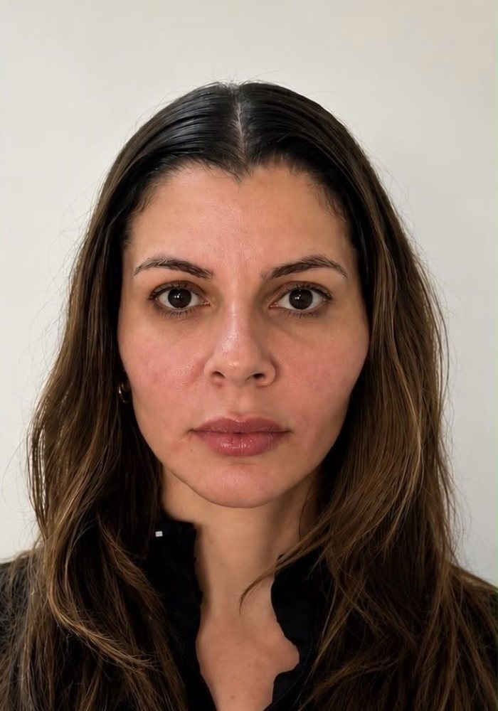 Rosto de frente depois da harmonização facial