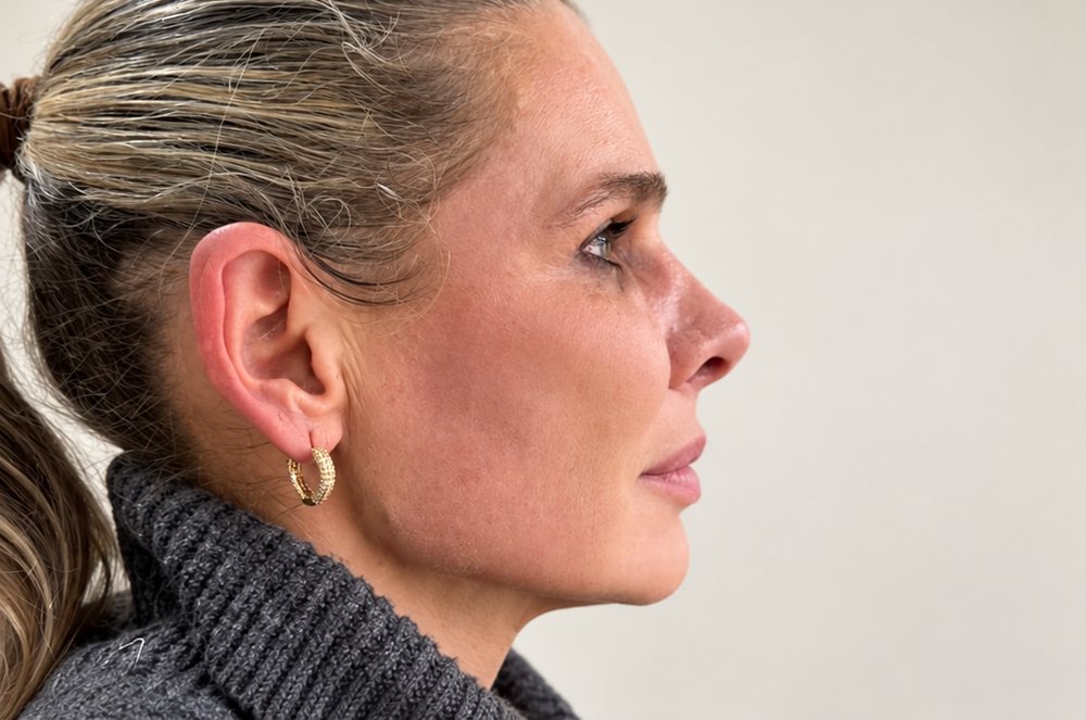 Perfil depois do tratamento, com melhora da flacidez