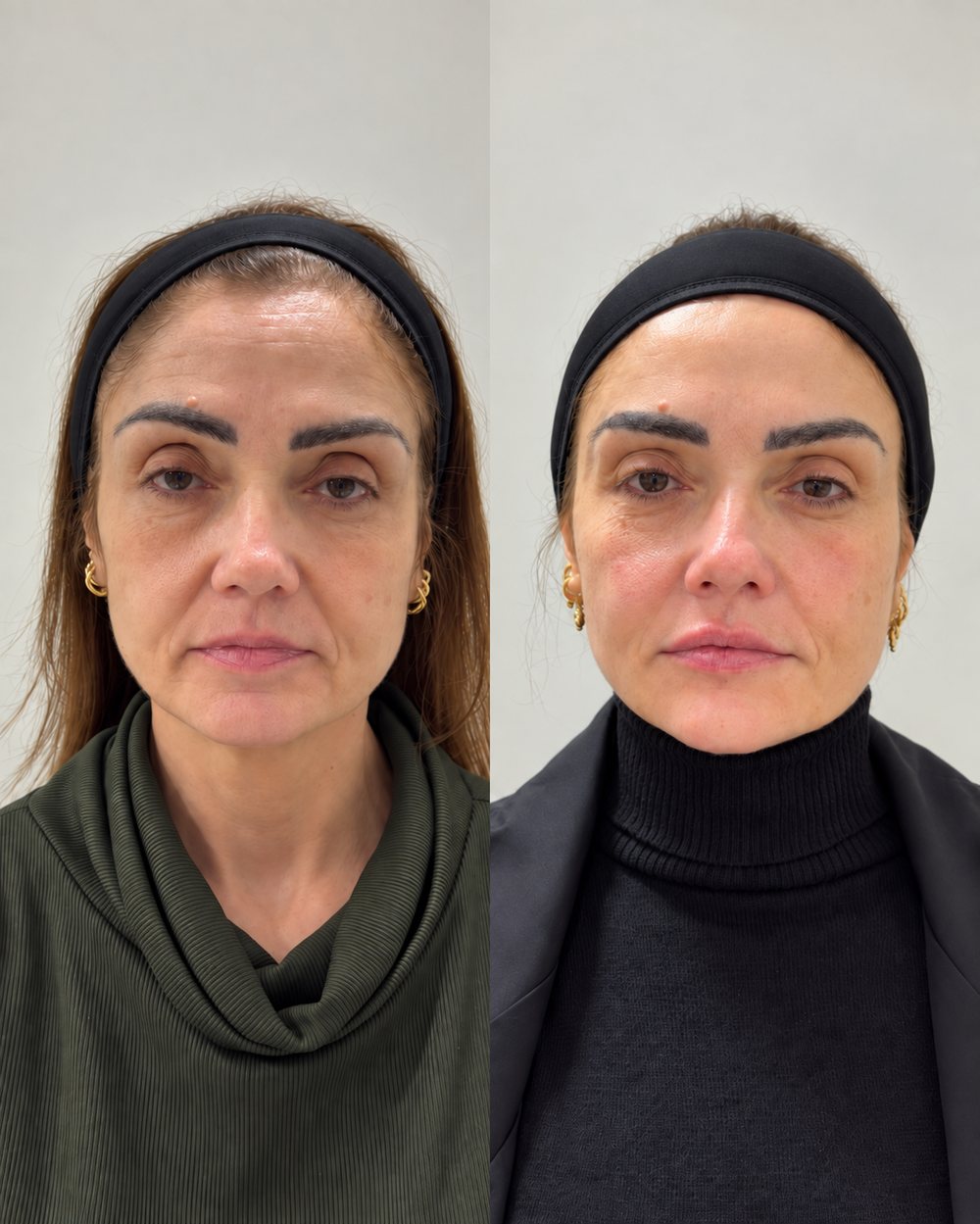 Antes e depois de rosto após emagrecimento