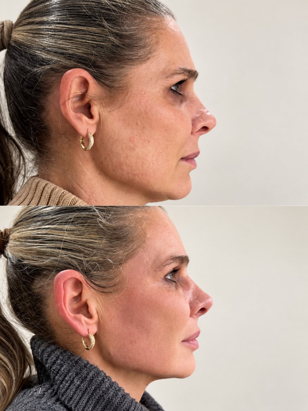 Antes e depois de perfil com melhora da flacidez